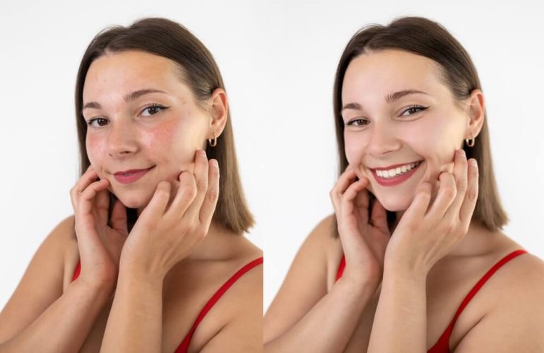 Microneedling in Tampa Florida