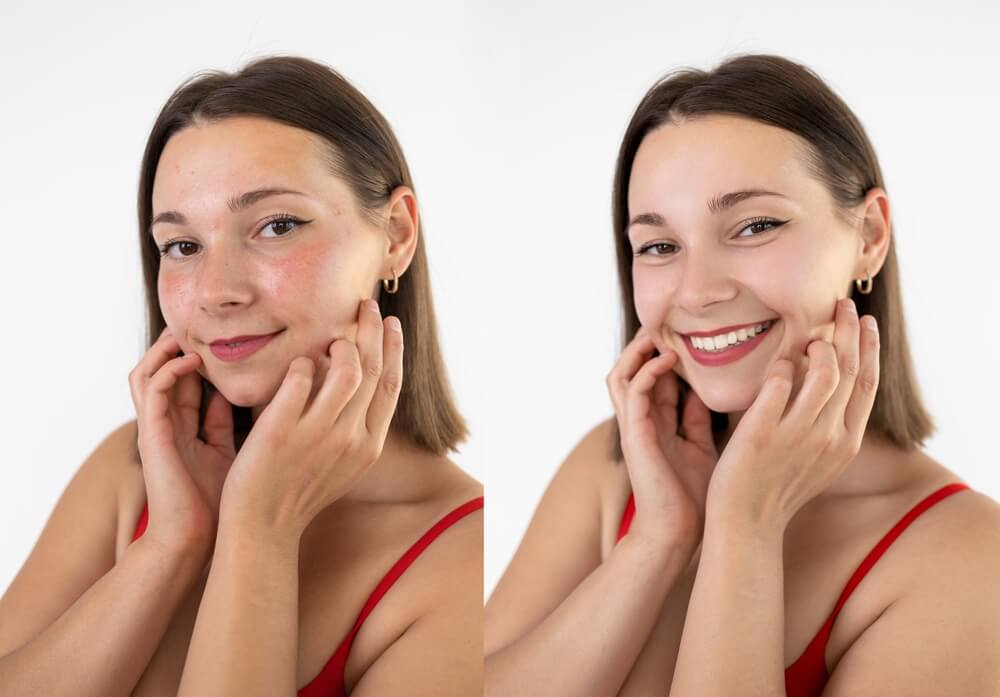 Microneedling in Tampa Florida