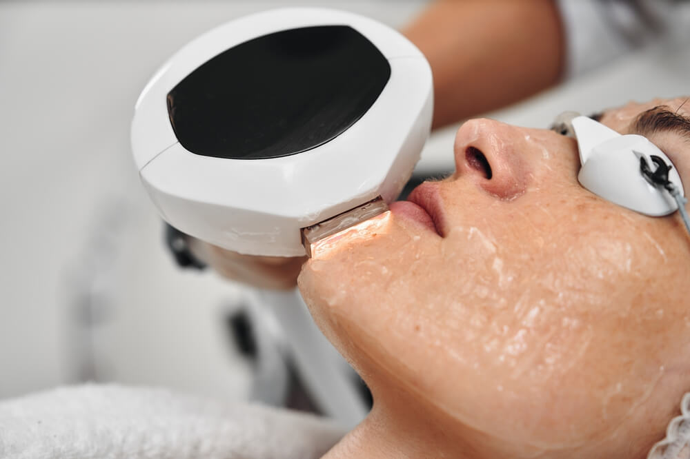 laser hair removal at clinic