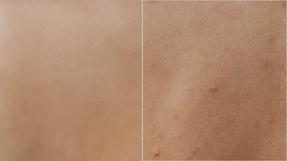 Microneedling in Tampa Florida