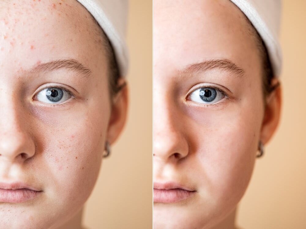 hydrafacial before and after