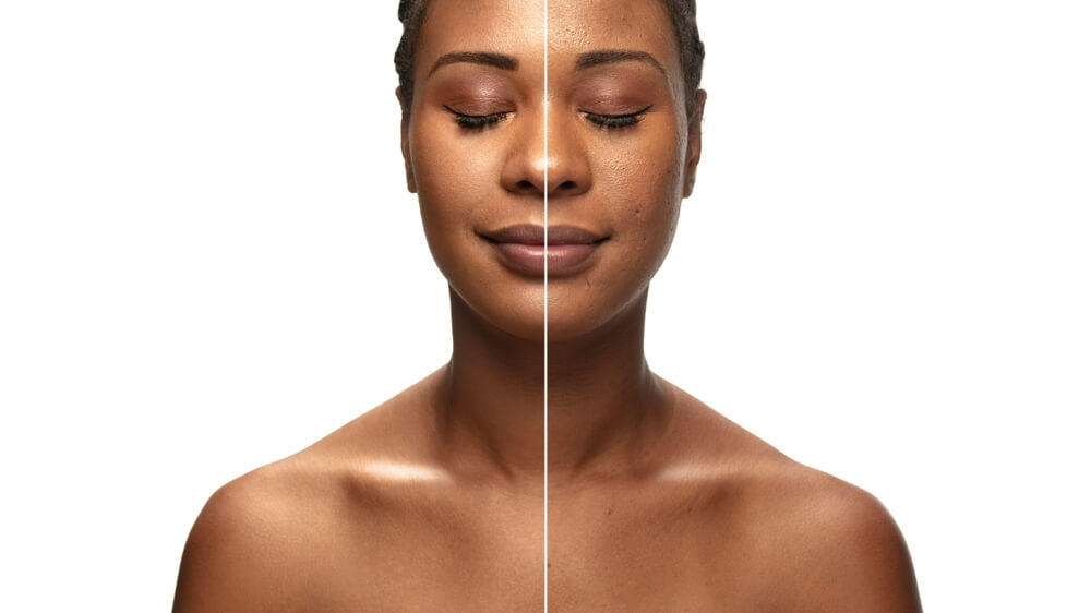 hydrafacial before and after