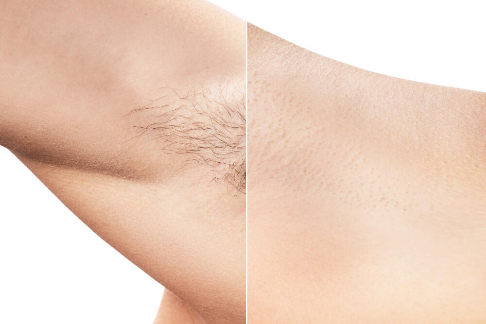 laser hair removal before and after. Candela laser hair removal is a cosmetic, non-invasive hair removal procedure