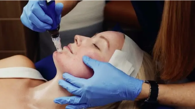 woman getting microneedling treatment from aesthetician