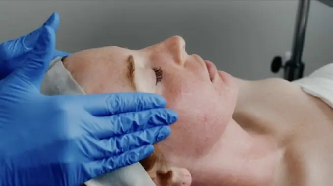 woman getting microneedling treatment
