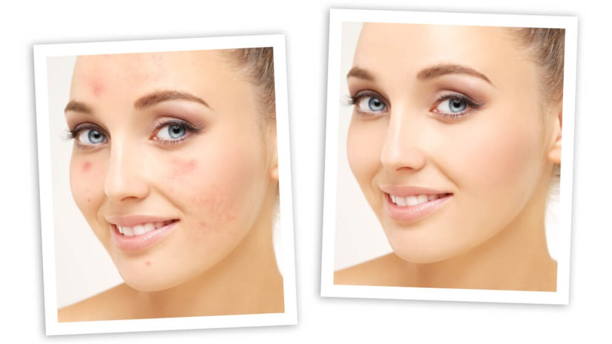 can semaglutide cause breakouts Weight-Loss Medications Like Ozempic and Mounjaro Acne? What You Need to Know Chest Acne: Physician-Guided Diagnosis &