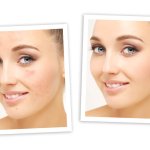Microdermabrasion in Tampa Oldsmar at health and medspa