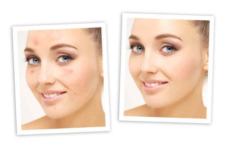 Microdermabrasion in Tampa Oldsmar at health and medspa