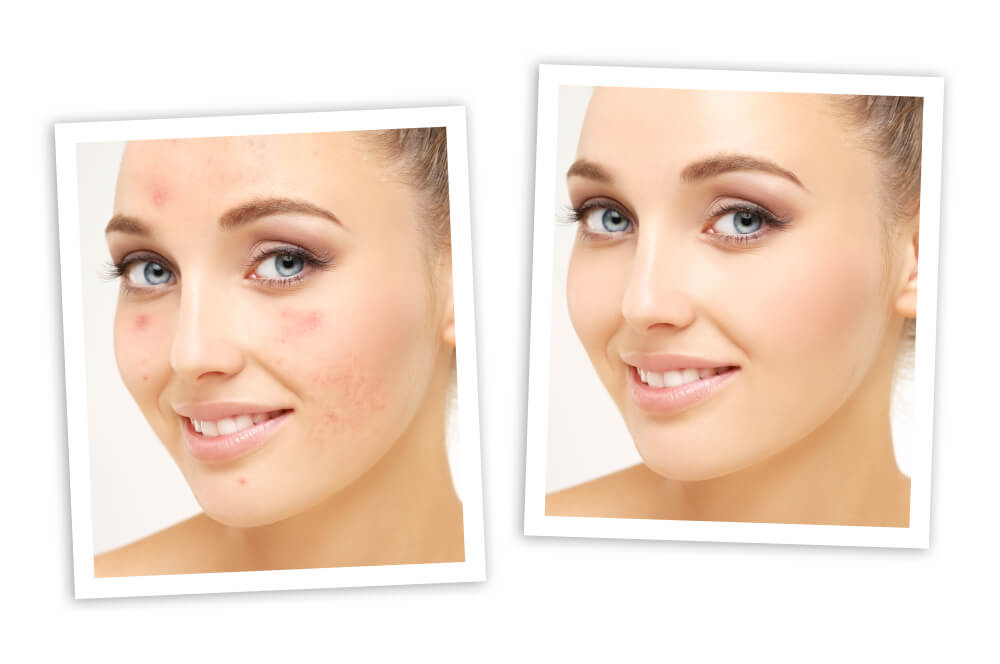 Microdermabrasion in Tampa Oldsmar at health and medspa