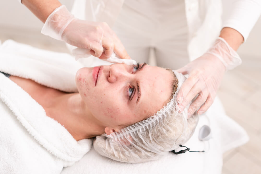 Who Is a Good Candidate for Microdermabrasion for Acne?