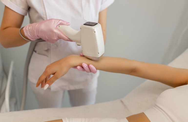 candela laser hair removal process