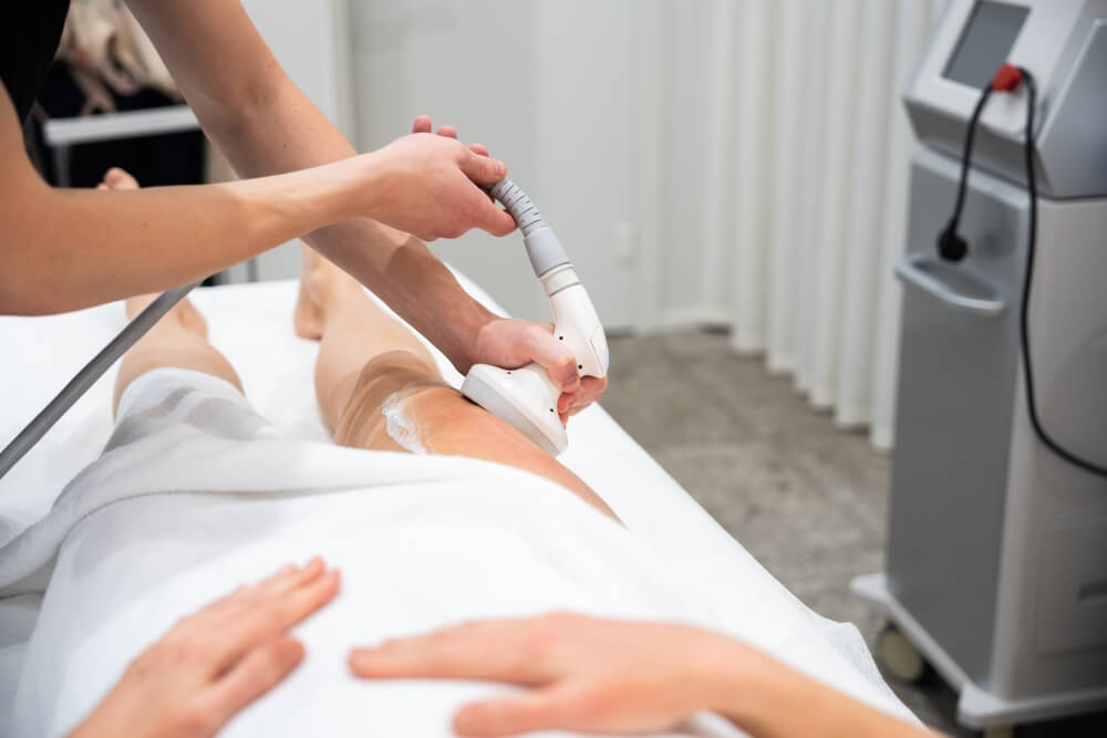 Candela laser hair removal is a cosmetic, non-invasive hair removal procedure