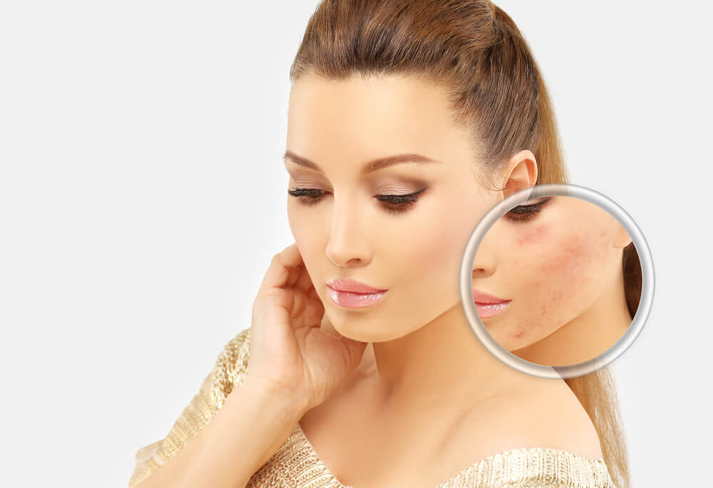 Microdermabrasion facial treats acne by a number of mechanisms: