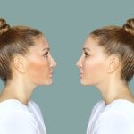 before and after results of Microneedling for Hyperpigmentation