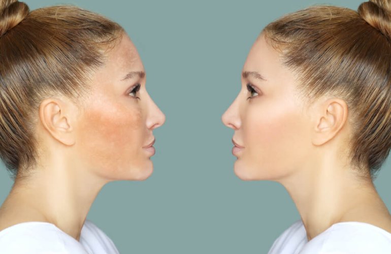 before and after results of Microneedling for Hyperpigmentation