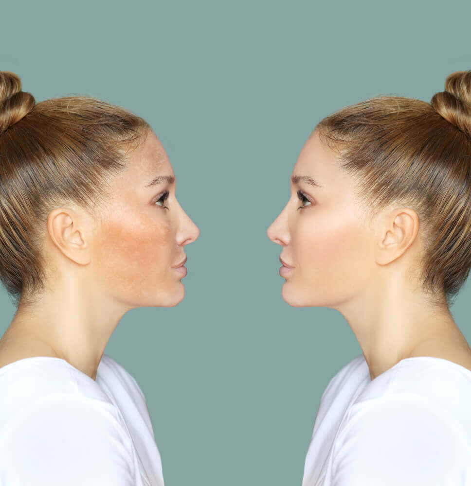 before and after results of Microneedling for Hyperpigmentation