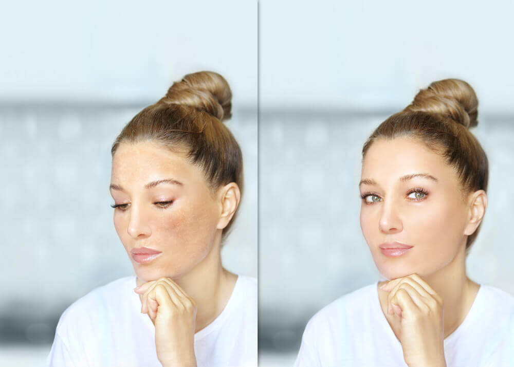 Microneedling Before and After Results!