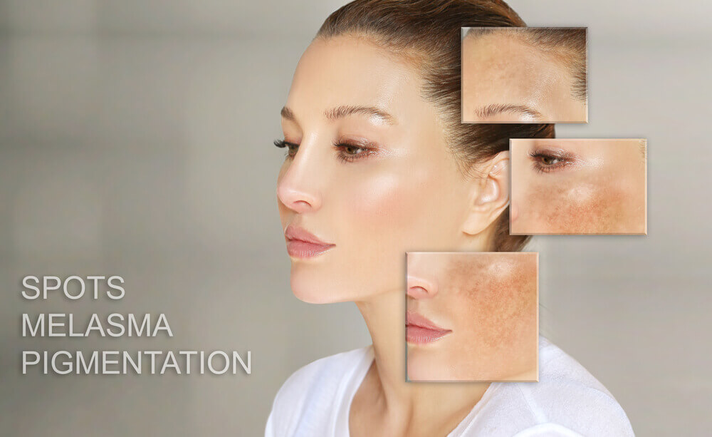 image showing after microneedling for hyperpigmentation results