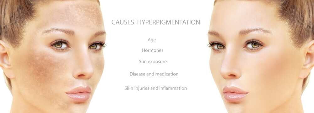 Common types of hyperpigmentation include: Sun spots (solar lentigines) Melasma Post-inflammatory hyperpigmentation (PIH) from acne or injury Age spots 