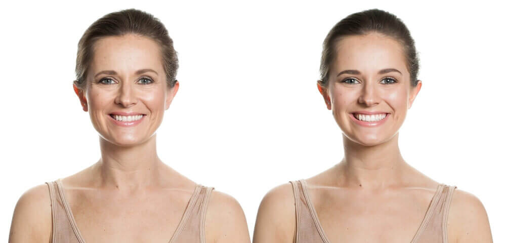 before and after comparison of acne reduction following several weeks of blue light phototherapy sessions.