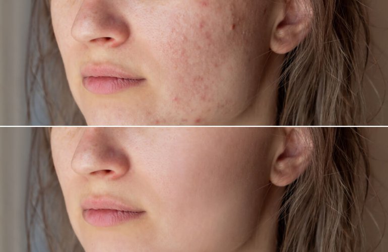Side-by-side comparison showing improvement in mild acne scars and skin texture after multiple microdermabrasion sessions.