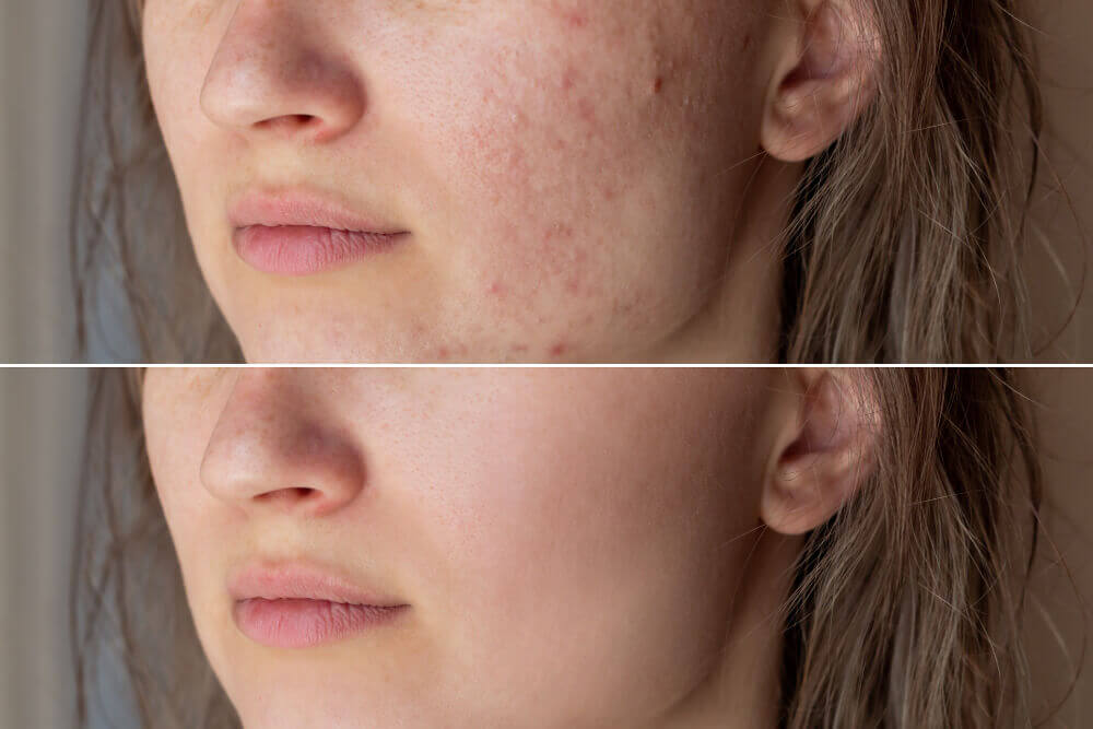 Side-by-side comparison showing improvement in mild acne scars and skin texture after multiple microdermabrasion sessions.