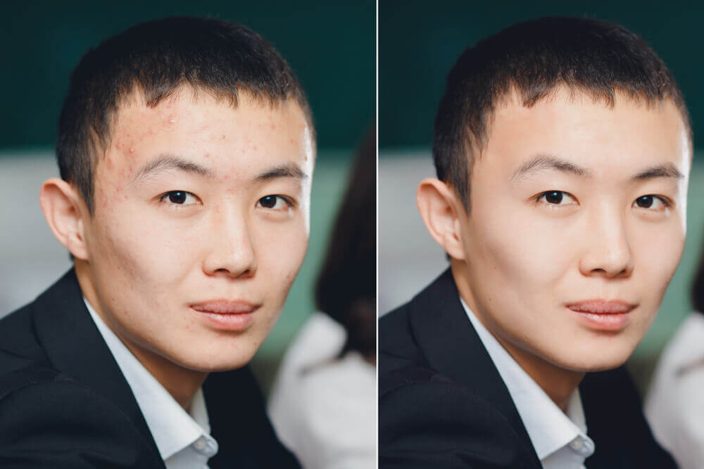 comparison showing improvement in mild acne scars and skin texture after multiple microdermabrasion sessions.