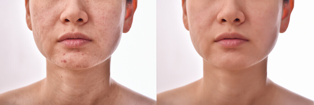 Side-by-side image showing improvement in acne scars after a series of chemical peel treatments, highlighting smoother and clearer skin.