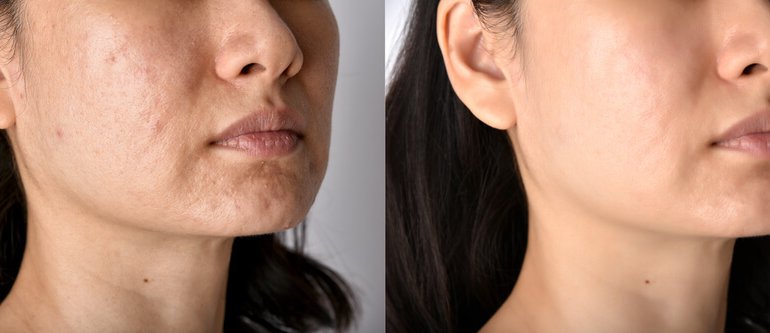 Side-by-side comparison showing improvement in mild acne scars and skin texture after multiple microdermabrasion sessions.