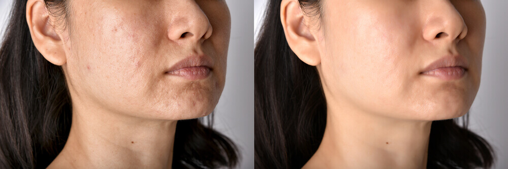 Side-by-side comparison showing improvement in mild acne scars and skin texture after multiple microdermabrasion sessions.