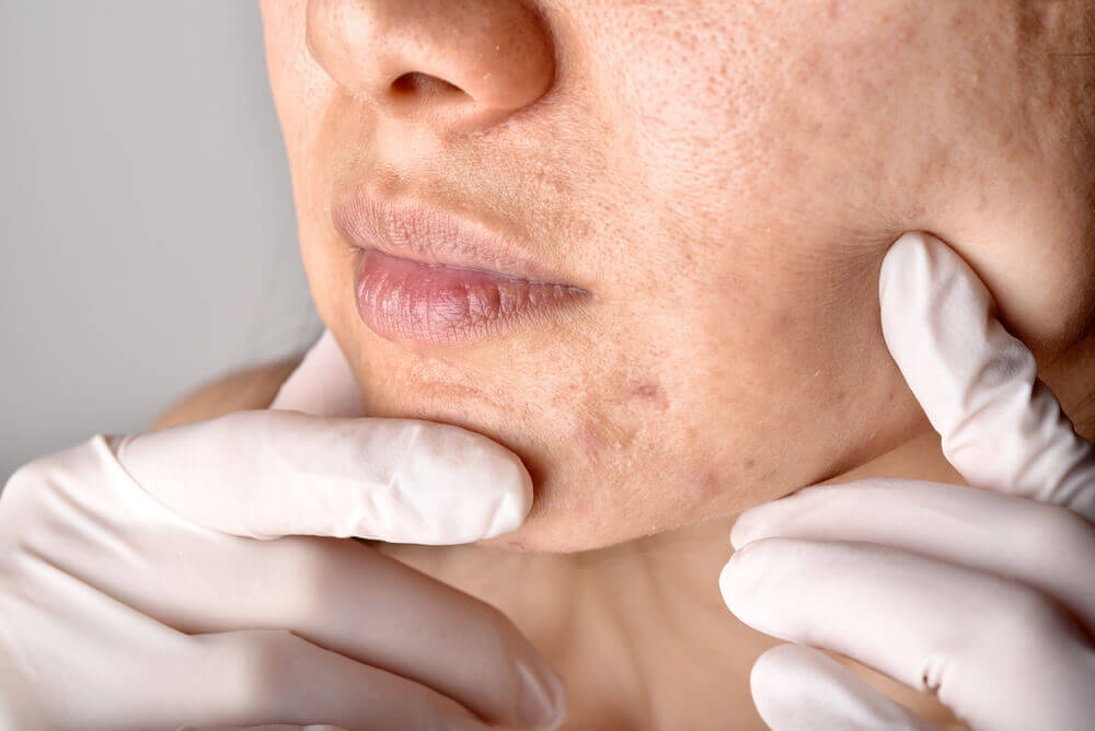 Close-up of skin with reduced dark marks after chemical peel, demonstrating fading of post-inflammatory hyperpigmentation (PIH).
