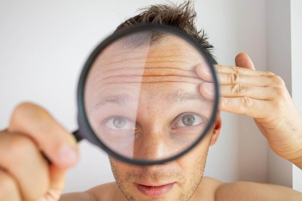 Close-up of deep forehead creases visible at rest demonstrating static wrinkles