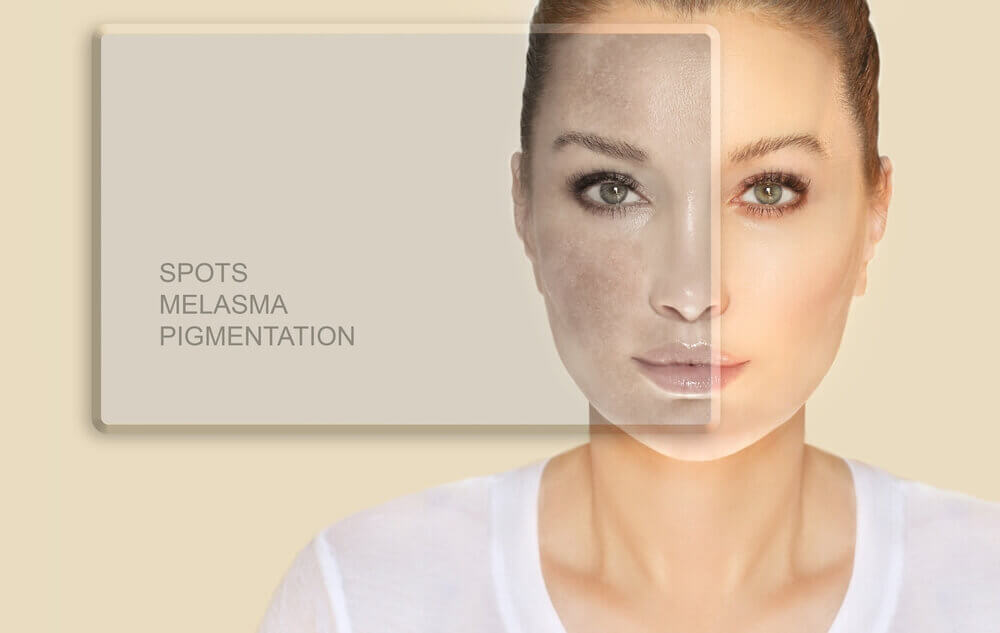Illustration of chemical peel benefits including improved skin texture, reduced acne scars, even skin tone, and boosted skin radiance.