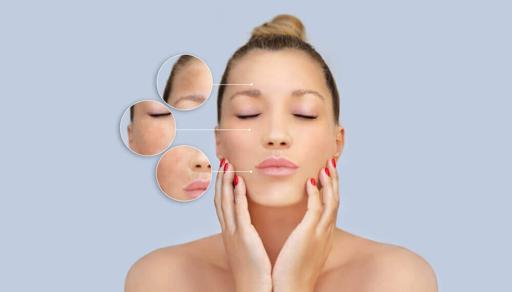 Smiling woman showing smooth and clear skin after a chemical peel, reflecting improved confidence and visible acne scar reduction.