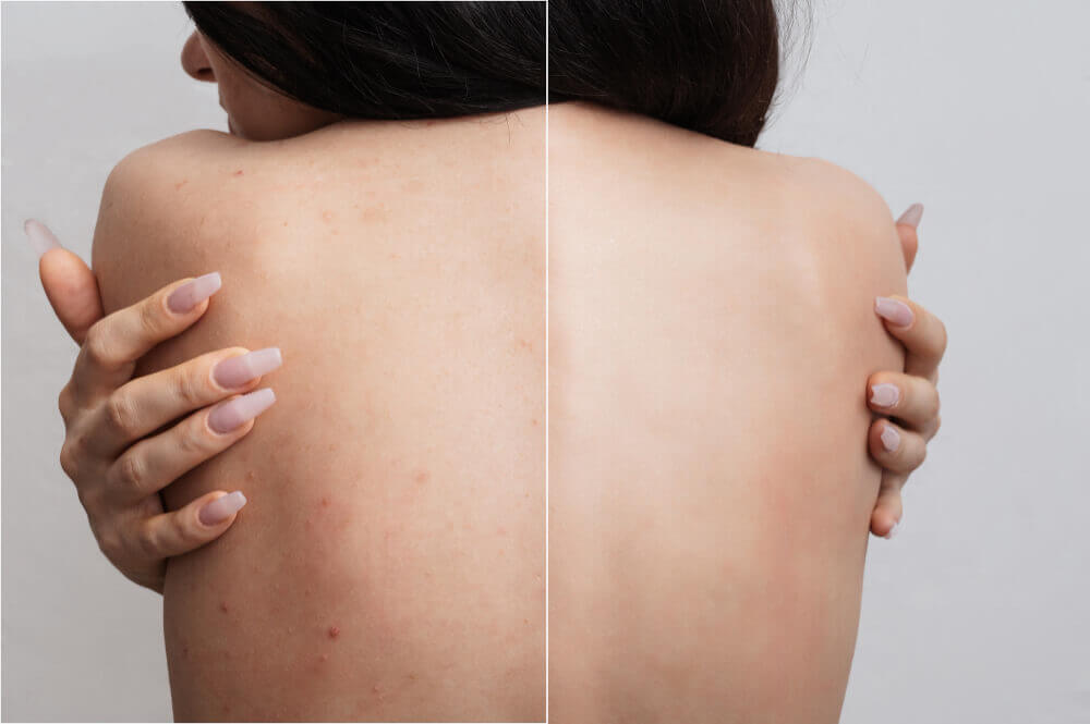 Back facial before and after results showing reduced acne and clearer skin