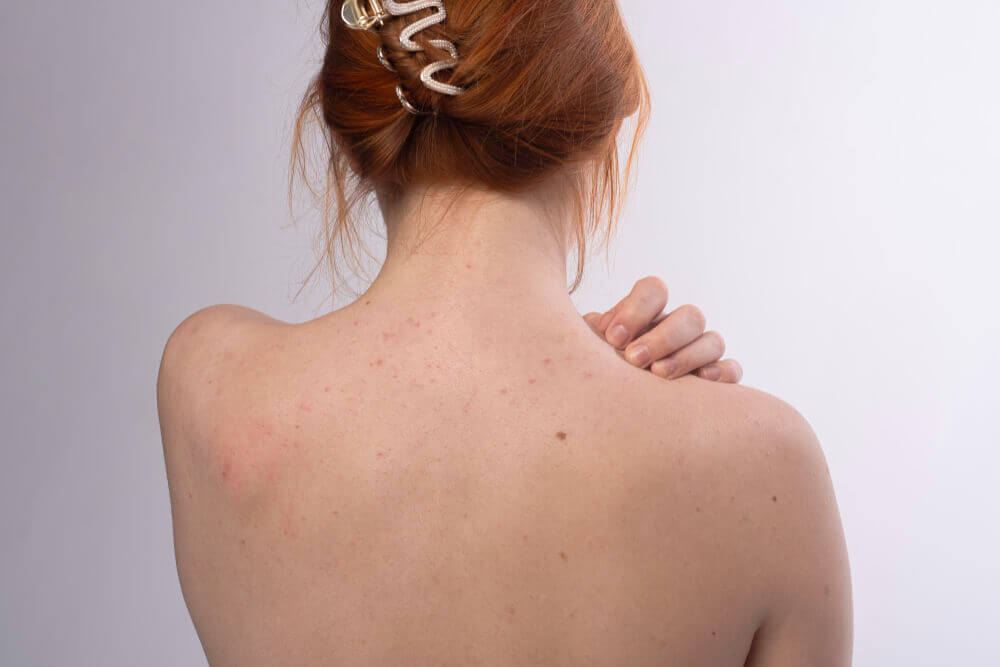 Back acne and clogged pores before a spa back facial treatment on a woman back