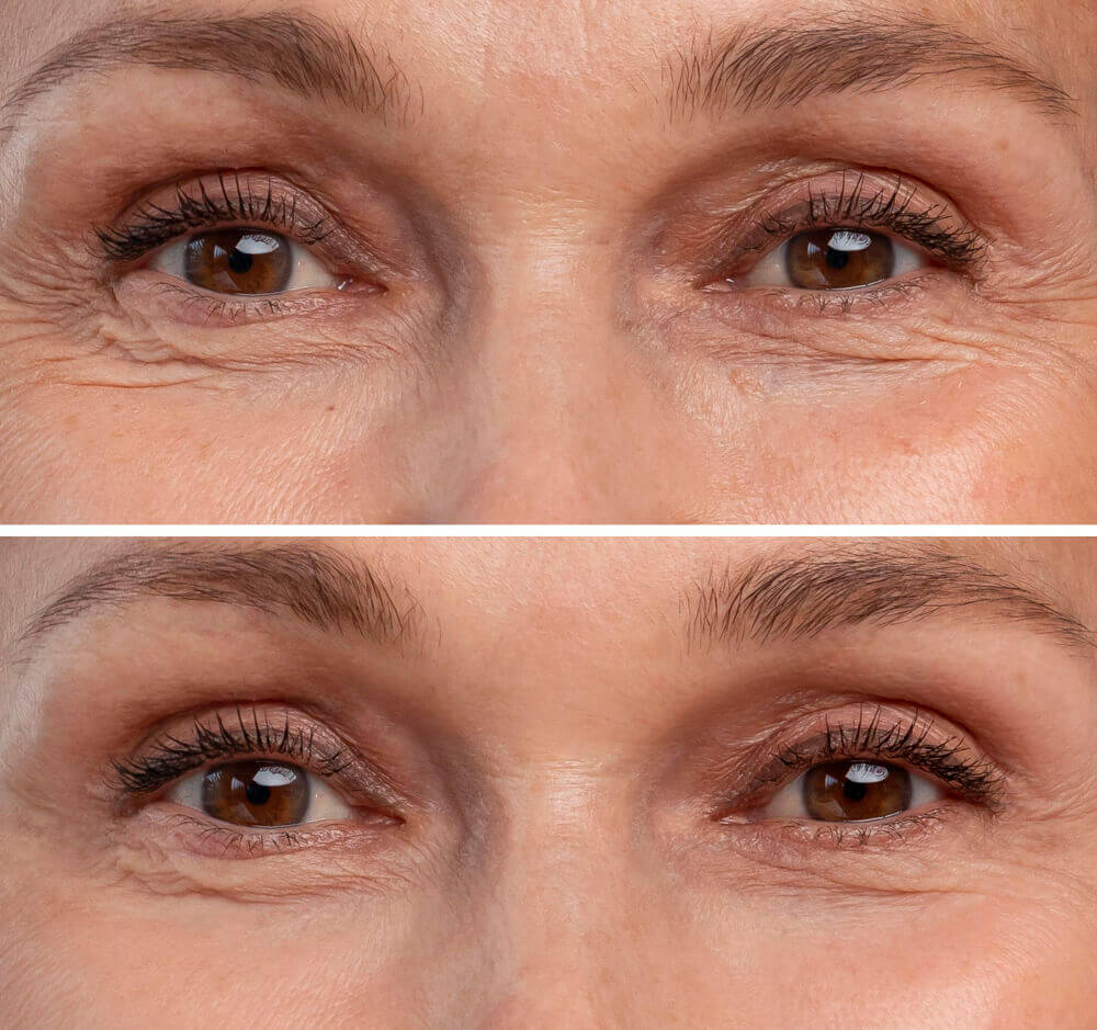 Botox for hooded eyes before and after showing lifted brows and refreshed eye appearance