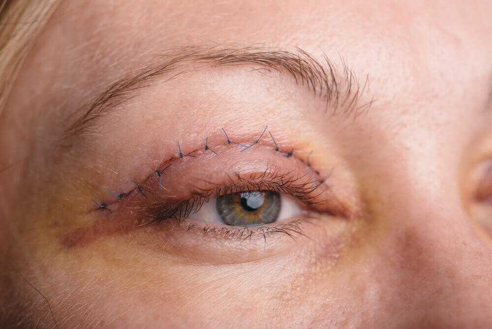 Blepharoplasty Surgical Eyelid Lift Results