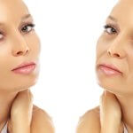 Before and after results of cheek fillers showing improved volume and lifted midface