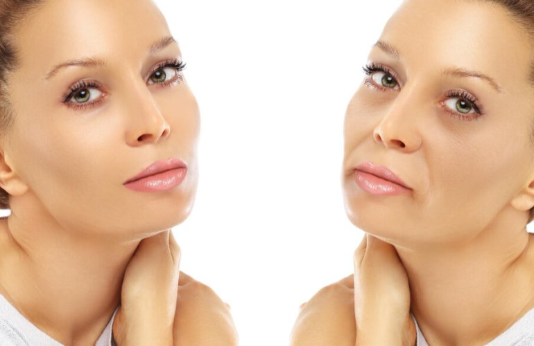 Before and after results of cheek fillers showing improved volume and lifted midface