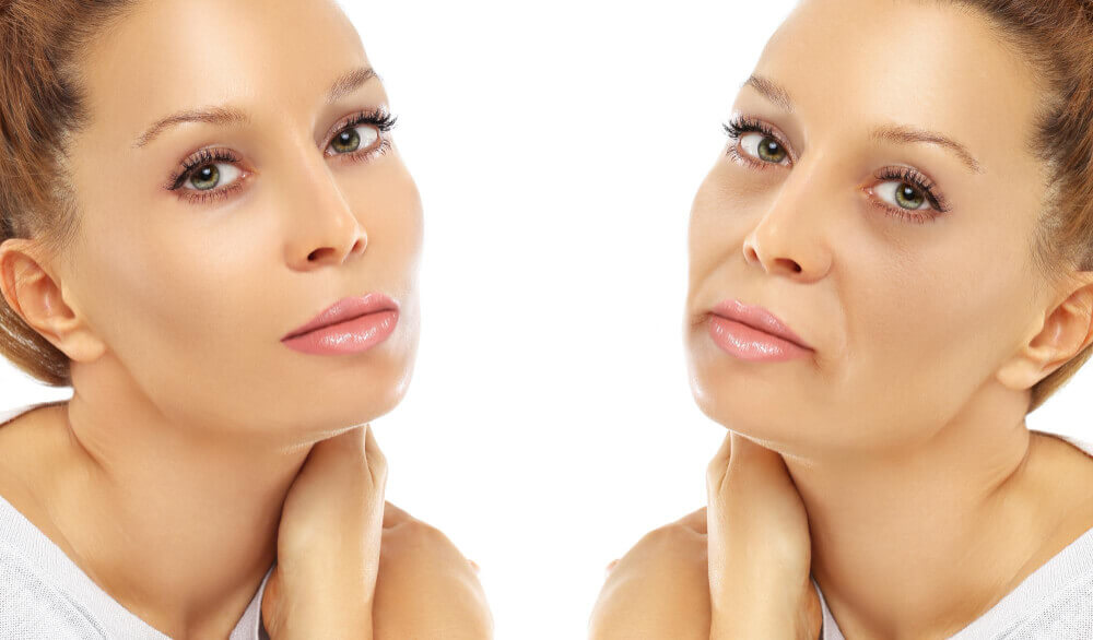 Before and after results of cheek fillers showing improved volume and lifted midface