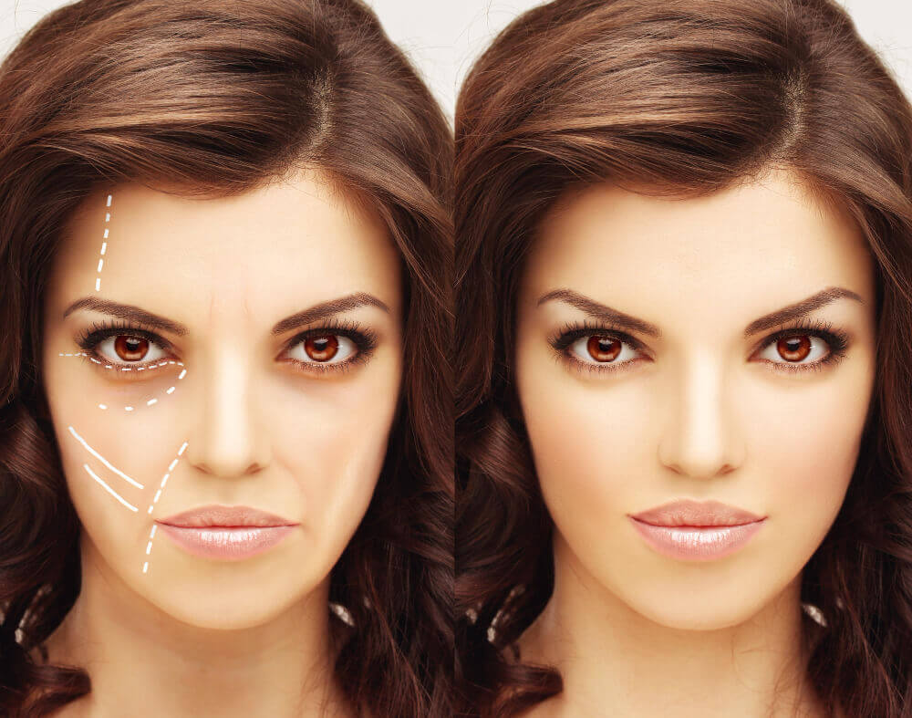 Before and after results of cheek fillers showing improved volume and lifted midface
