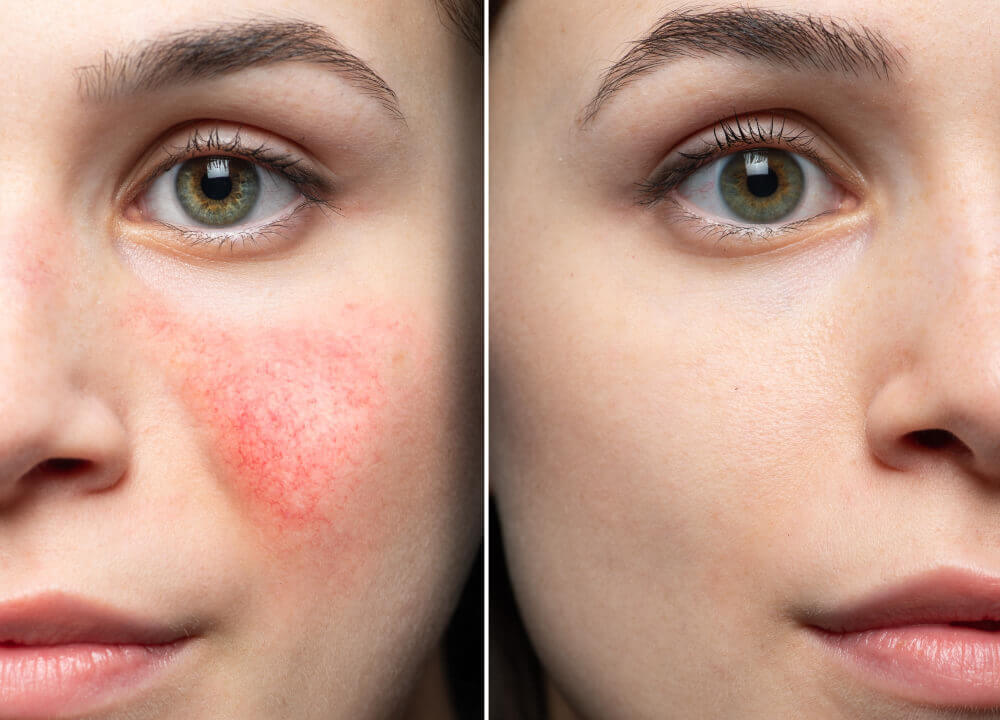 Before and after comparison showing reduction in facial redness using yellow LED light therapy for sensitive skin.