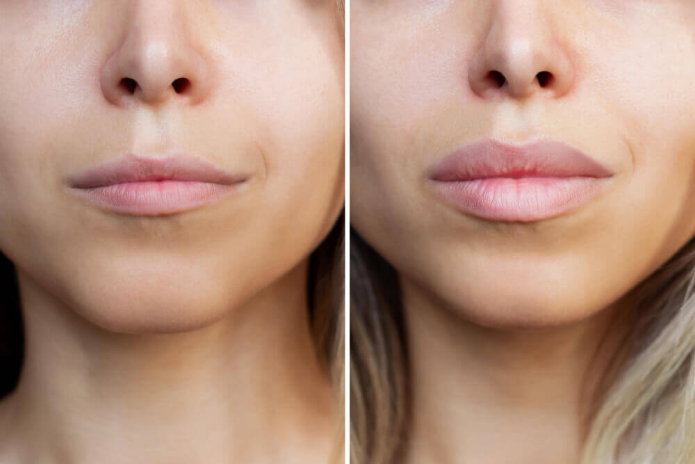 Before and after comparison showing reduced smile lines and smoother skin after Botox treatment.