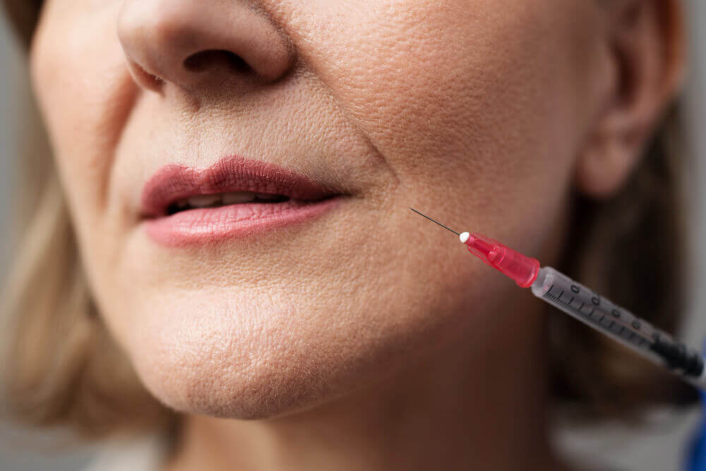 Close-up of dermal filler injection being used to soften nasolabial folds and restore facial volume.