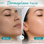 Before and after results of dermaplaning facial showing smoother brighter skin
