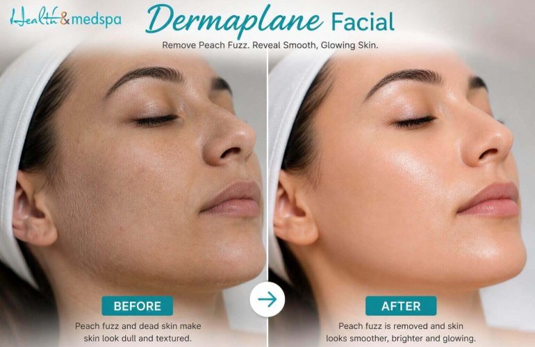 Before and after results of dermaplaning facial showing smoother brighter skin