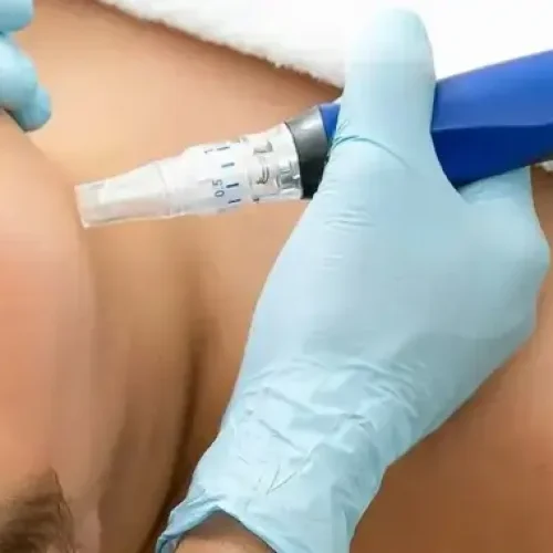 microneedling-inflamation