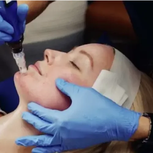 microneedling-profilation