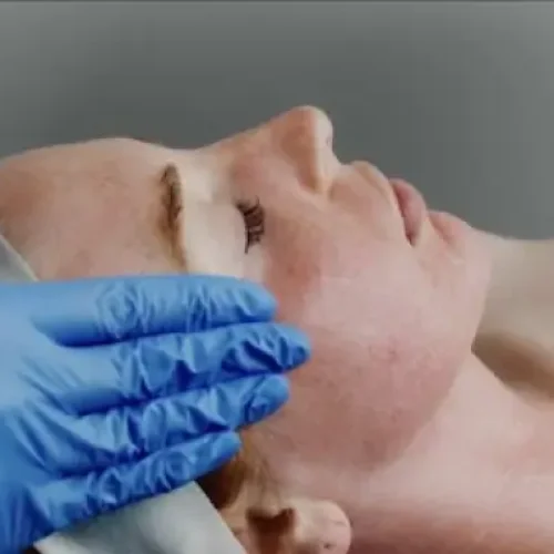 microneedling-remodeling